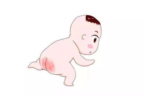 一个月的宝宝红屁屁怎么办