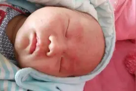 宝宝湿疹、痤疮、红斑……新生儿常见的10种皮肤问题，这么处理图片