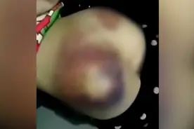 南阳一老师体罚一年级学生将屁股打至黑紫 只因做练习题反复出错视频封面