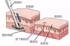 解析大腿吸脂后遗症以及吸脂手术禁忌图片