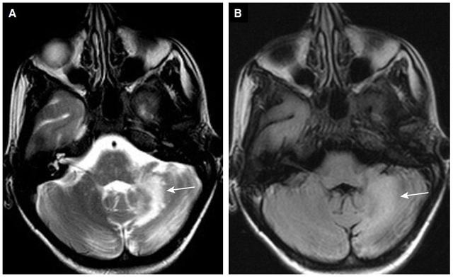 表格总结+实战读片：掌握急性小脑性共济失调的常见病因及诊断线索丨临床必备