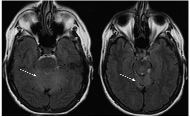 表格总结+实战读片：掌握急性小脑性共济失调的常见病因及诊断线索丨临床必备