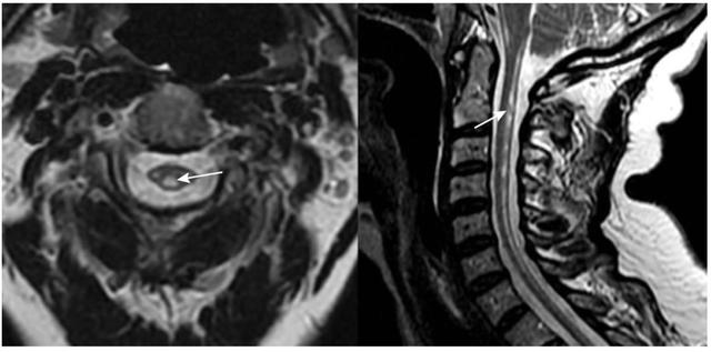 表格总结+实战读片：掌握急性小脑性共济失调的常见病因及诊断线索丨临床必备