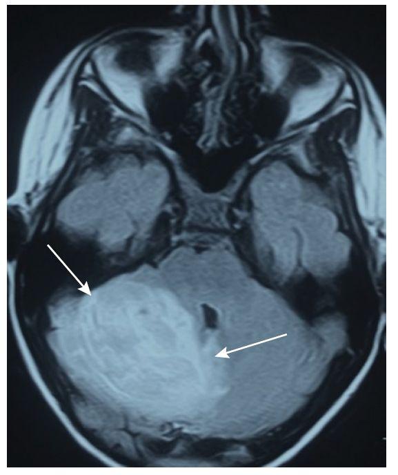 表格总结+实战读片：掌握急性小脑性共济失调的常见病因及诊断线索丨临床必备