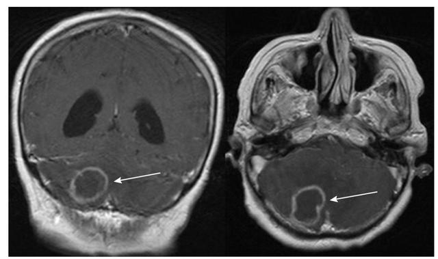 表格总结+实战读片：掌握急性小脑性共济失调的常见病因及诊断线索丨临床必备