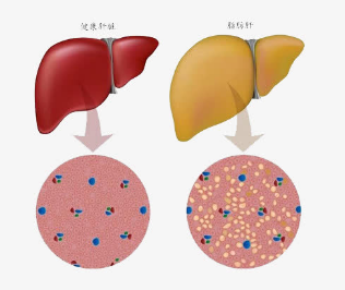 脂肪肝莫慌张，逆转脂肪肝的方法在这里