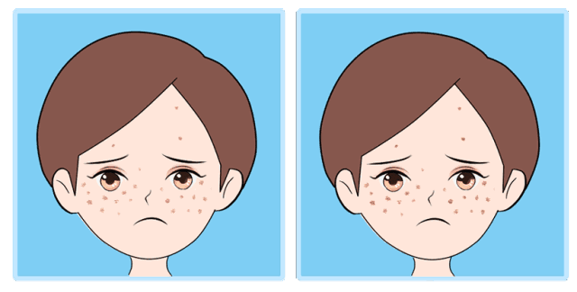 溢脂性角化病激光治疗后