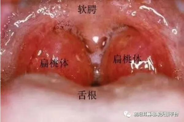 扁桃体角化症药物