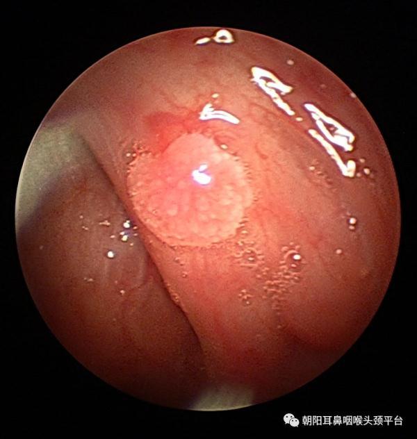 扁桃体角化症药物