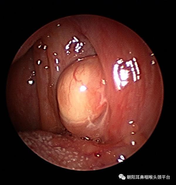 扁桃体角化症药物