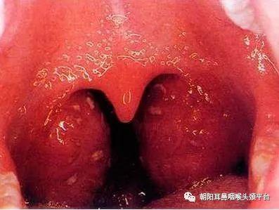 扁桃体角化症药物