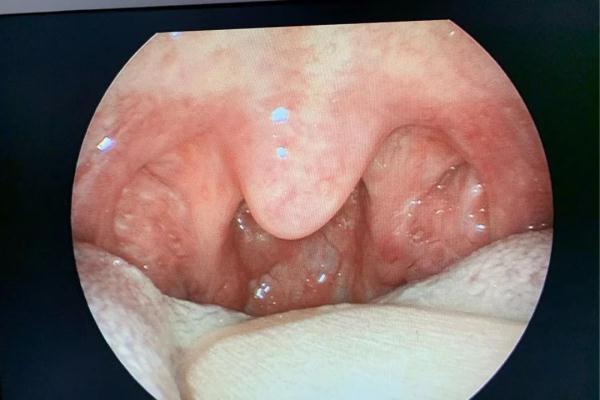 扁桃体角化症药物