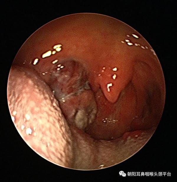 扁桃体角化症药物
