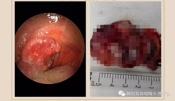 扁桃体角化症药物