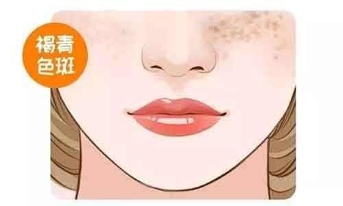 溢脂性角化病激光治疗后