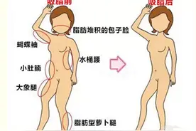 大腿吸脂达到美腿标准凹凸不平怎么办？图片