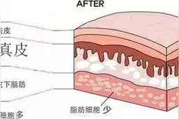 吸脂手术分部位解析吸脂难度和后遗症发生可能图片
