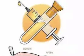 吸脂手术原理，有没有后遗症？图片