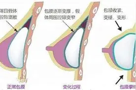 假体隆胸的威胁包膜挛缩你真的了解吗？图片