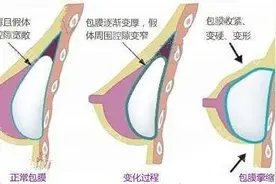假体隆胸手术有后遗症吗？能避免吗？图片