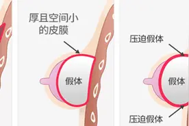 不同隆胸假体品牌质量不同，价格会有很大差异吗图片