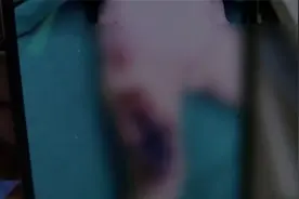火碱洗地隐患大！1岁半女童摔倒致大面积烧伤需植皮图片