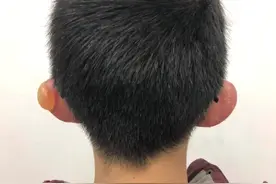 长春男童“光头”户外狂踢足球 致二度冻伤 两耳起疱 医生这些建议可以防止冻伤图片