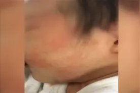 护士发现刚出生两天的孩子身上长红疹，奶奶成了“罪魁祸首”？视频封面