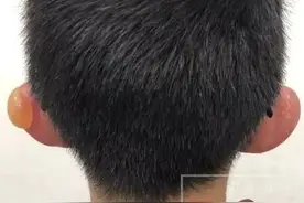 「心疼」看着就疼！长春男孩大冷天踢足球冻伤！这些细节值得家长注意…图片