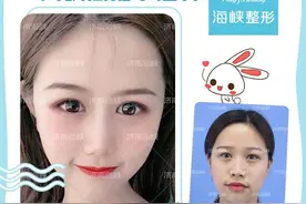鼻子过短怎么整？图片