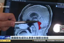 罕见！美国医生成功从患者大脑取出绦虫视频封面
