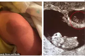 胎死腹中却将B超影像留在双胞胎弟弟腿上 妈妈：姐姐被弟弟吸收了图片