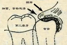 线上问医｜疫情期间发生急性冠周炎？烟台专家教你这样处理图片