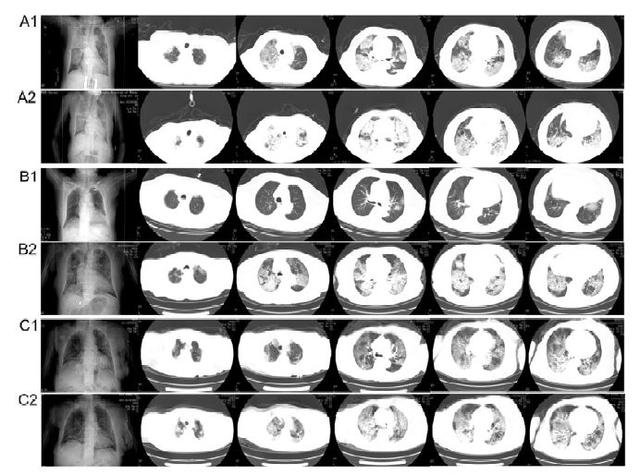 25例COVID-19死亡病例临床特征：肺损伤最常见，其次是心脏，细菌感染可能促进死亡