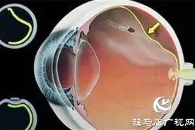 一只眼睛视网膜脱落，另一只也会脱落吗图片