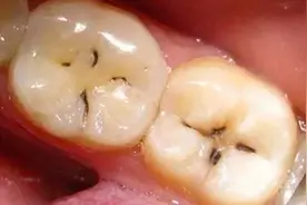 牙齿上的黑线是什么鬼？洗牙可以洗掉吗？图片
