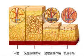 腿部吸脂手术效果如何？会不会产生凹凸不平？图片
