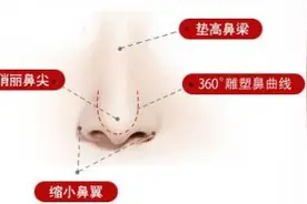 什么是综合鼻整形？——白晓东整形科普系列图片