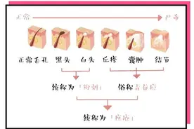 宅家胡吃海喝脸上爆痘，这波操作拯救你图片
