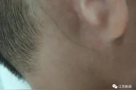 4岁男孩皮肤下有一根黑线，还会延长移动！医生惊了：中国仅3例图片