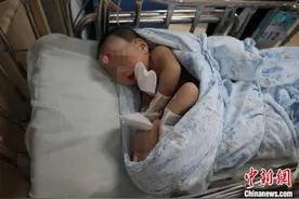 上海专家成功精准分离出生36天肝脏相连联体婴儿图片