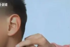 徐州4岁男孩皮肤下有一根黑线，还会延长移动？医生：中国仅3例！视频封面