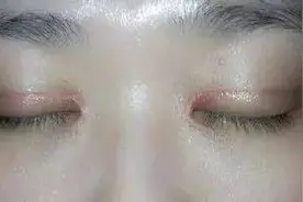 “我花了3w做的双眼皮，相亲对象10米开外就看出来？！”图片