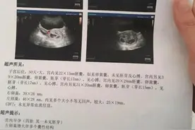 浙江男子带老婆做孕检，一查肚子里竟有4个...网友算了笔帐，一般人真不知道图片