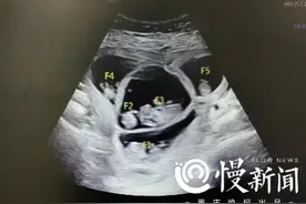 多年不孕一朝五胞胎，却发现胎儿异常！“减胎术”助孕妈成功“五减三”图片
