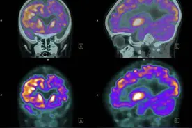 癫痫吃药控制不住？癫痫患者是否需要手术？图片