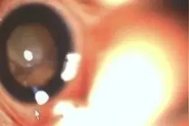 8个月的婴儿到晚上眼睛会反光，原来是重病图片