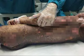 罕见“怪病”，一年才接诊3例，6岁的她最严重图片
