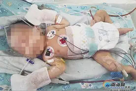 1/50万的发生率！海口男婴出生13天 肚里取出个“寄生胎”图片