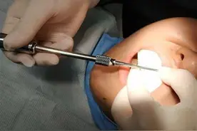 网购隐形牙套DIY，权威正畸专家说NO图片